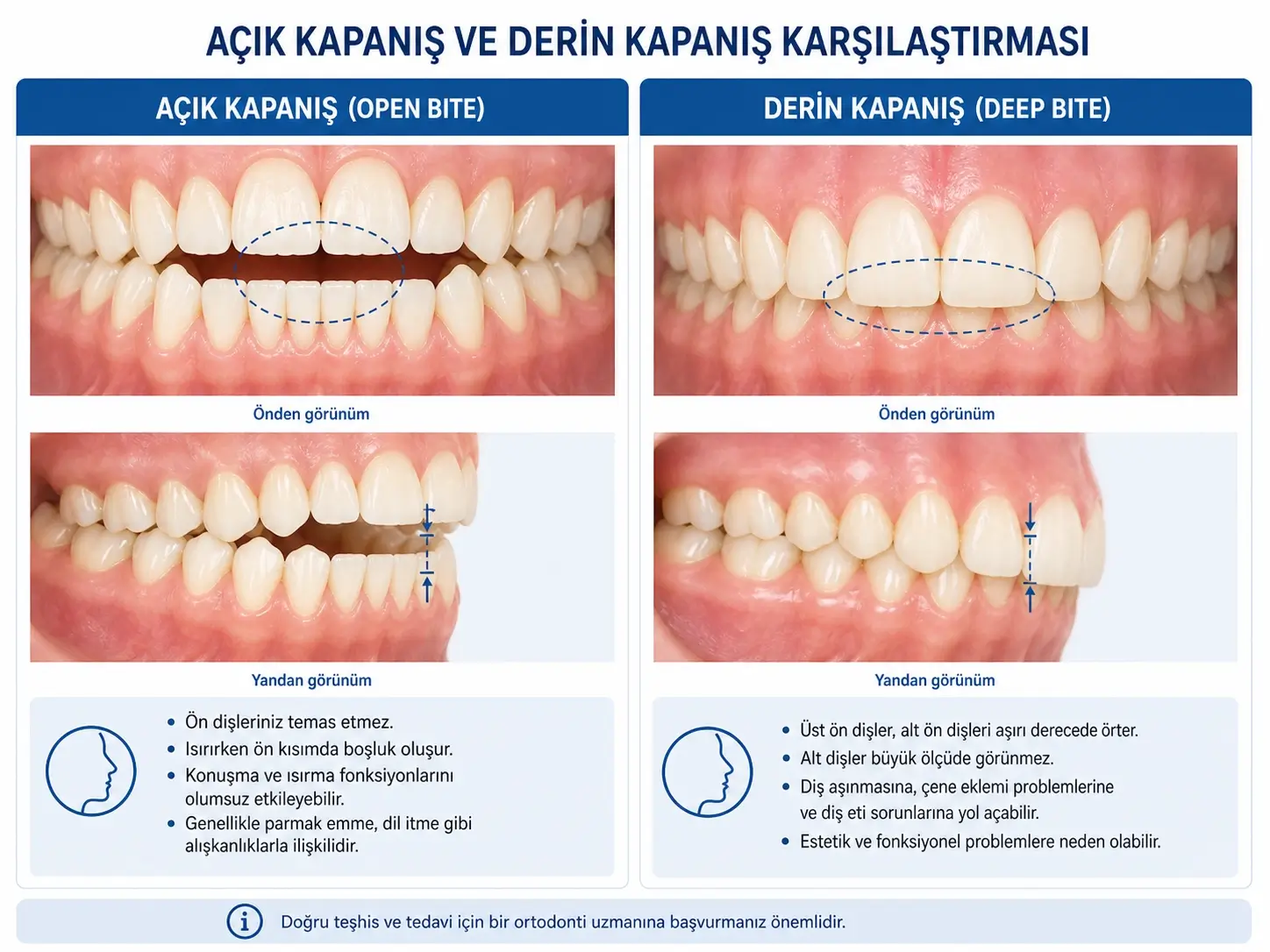 Açık kapanış ve derin kapanış diş yapısı karşılaştırması