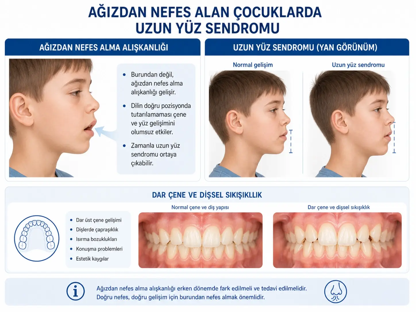 Ağızdan nefes almanın çene ve yüz gelişimine etkisi